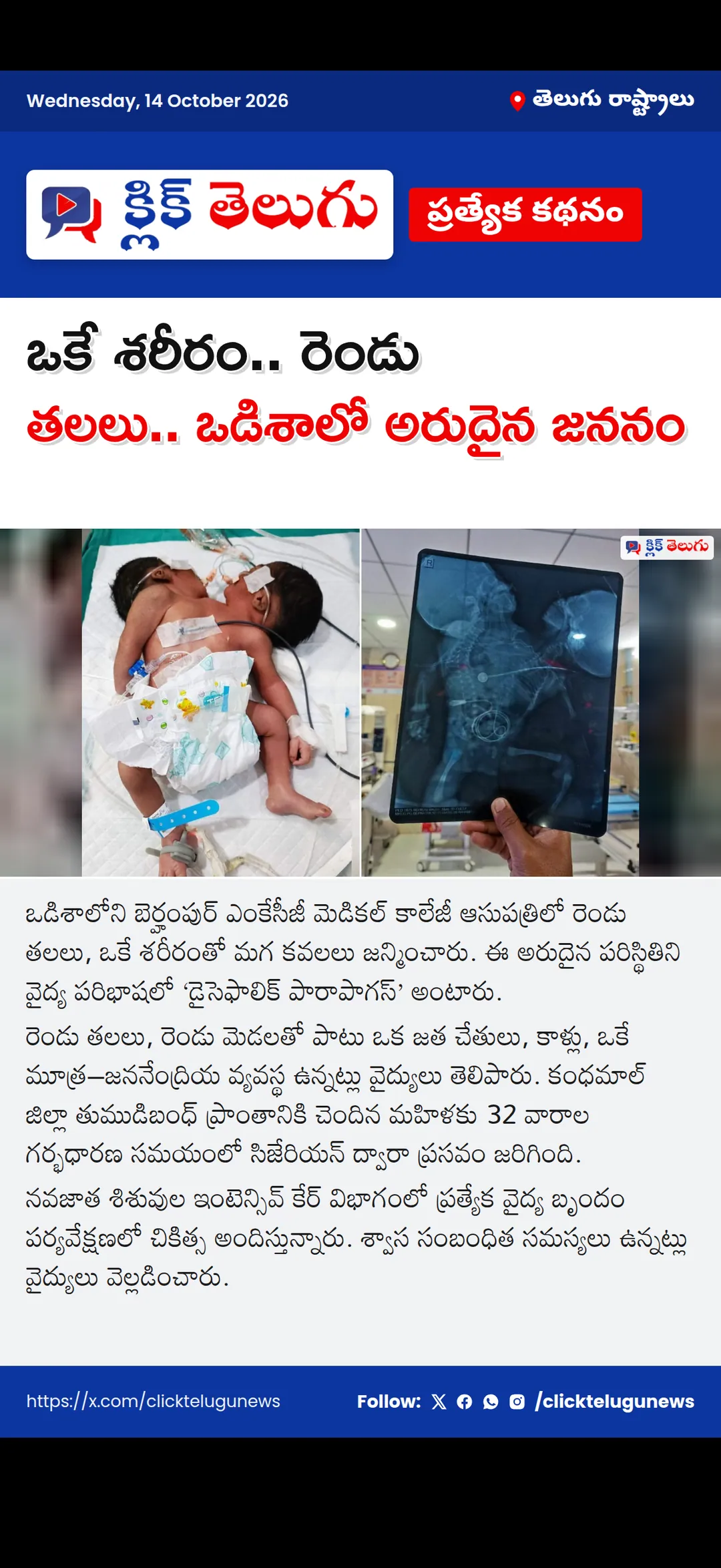 ఒకే శరీరం.. రెండు తలలు.. ఒడిశాలో అరుదైన జననం